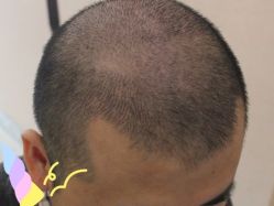 -大麦微针植发丨全国连锁