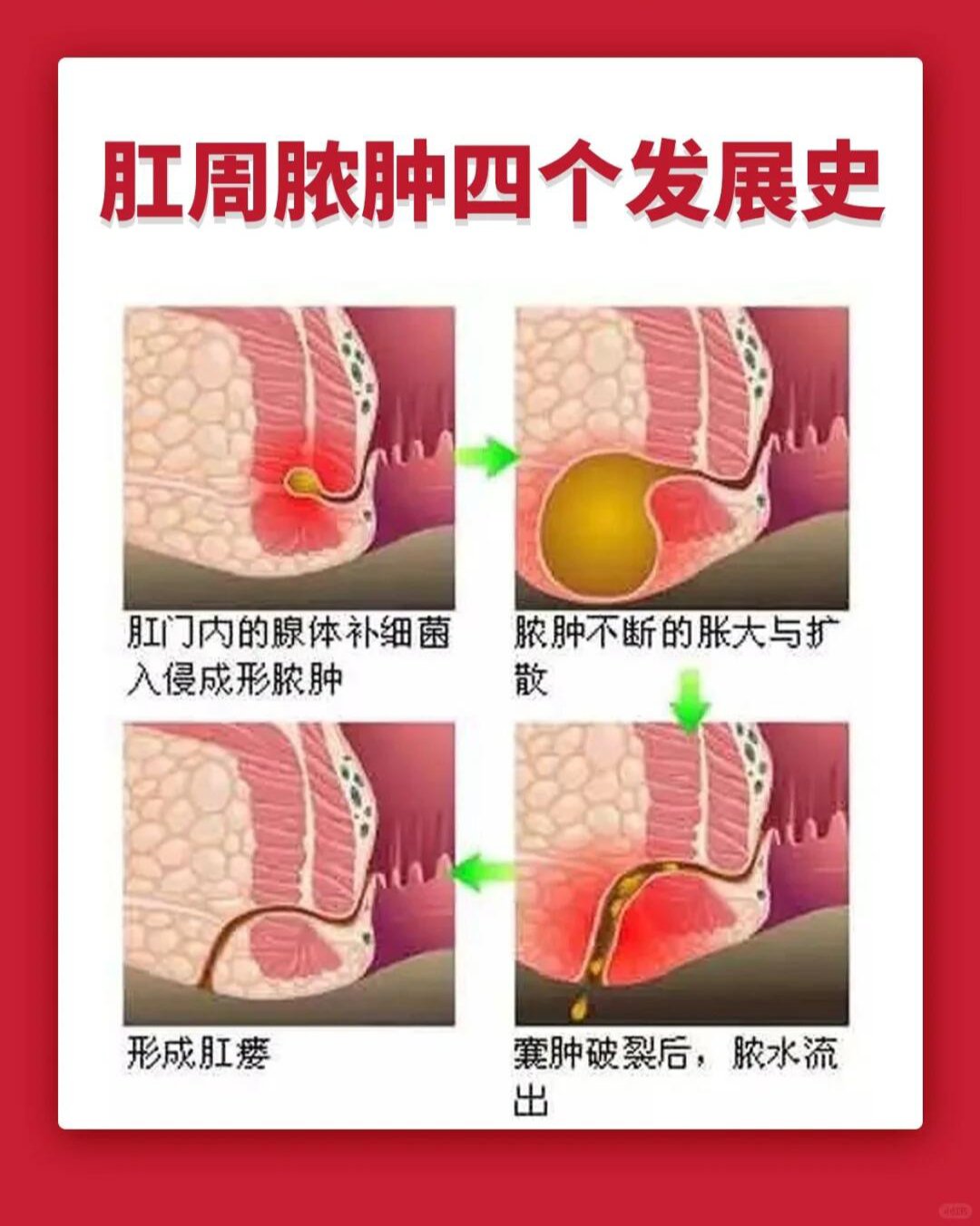 肛周脓肿最好别做手术图片