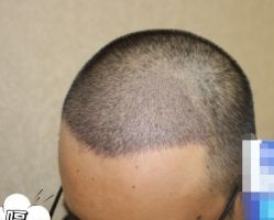 -大麦微针植发丨全国连锁