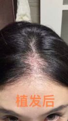 -碧莲盛·不剃发植发