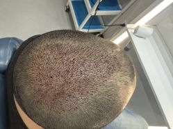 体验后-大麦微针植发全国连锁