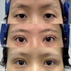 -广州健丽·去眼袋医疗美容机构