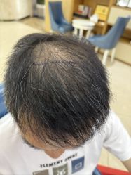 -大麦微针植发全国连锁
