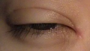 拆线第二天-上海华安整形外科门诊部