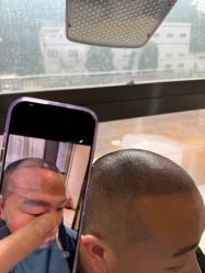 -碧莲盛·不剃发植发