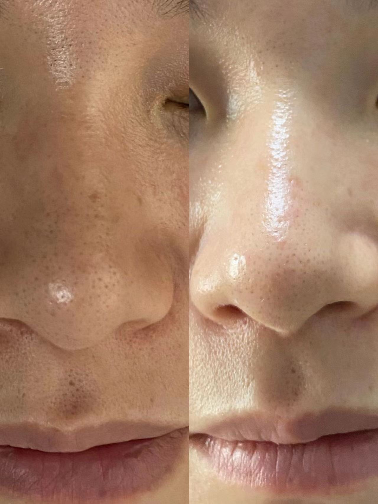 收缩毛孔大作战