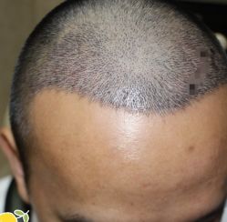 -大麦微针植发丨全国连锁