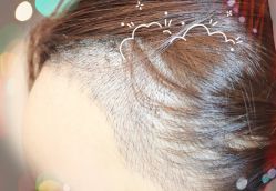 -大麦微针植发全国连锁