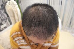 点击看大图 -大麦微针植发丨全国连锁