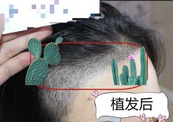 -大麦微针植发全国连锁