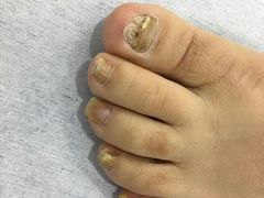 -世龙世家灰指甲·甲沟炎·跖疣护理·修脚(东江湾路店)