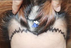 -大麦微针植发全国连锁