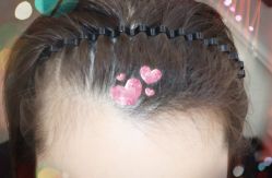 -大麦微针植发全国连锁