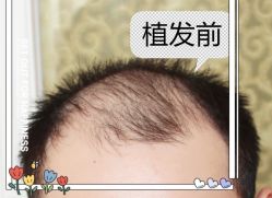 -大麦微针植发全国连锁