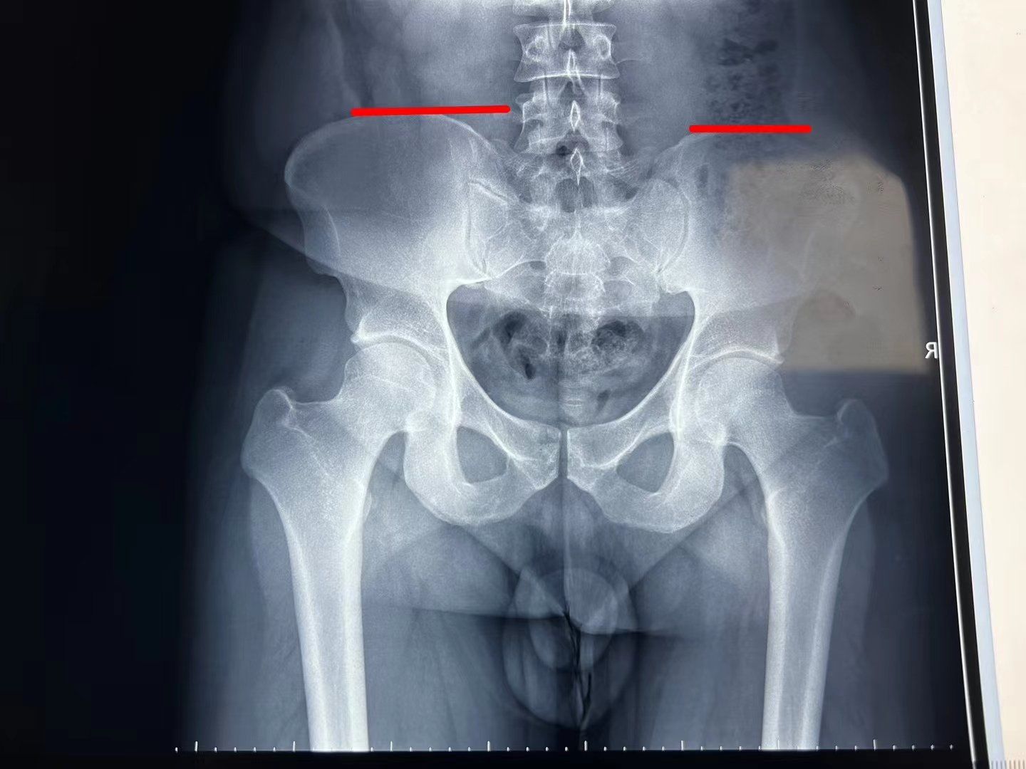 影像中的骨盆高低