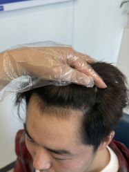 体验后-大麦微针植发全国连锁