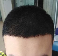 -大麦微针植发丨全国连锁