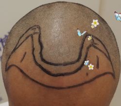 -大麦微针植发全国连锁