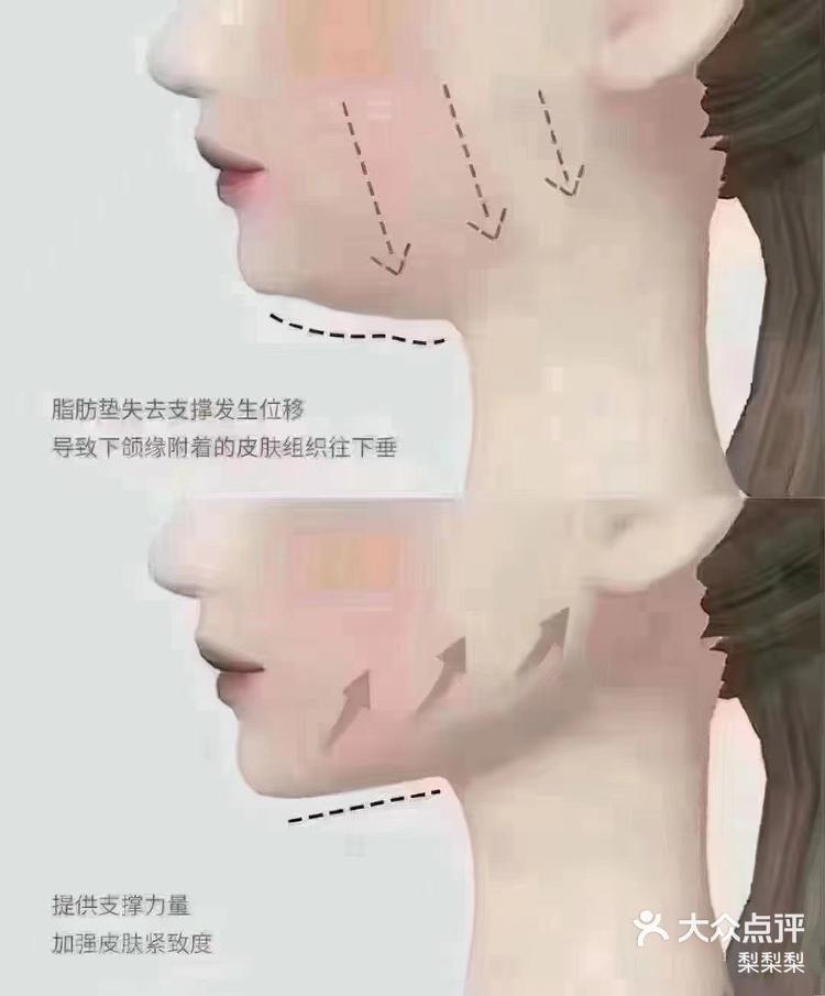 什么叫下颌线?下颌线也叫轮廓线,主要表