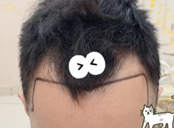 -大麦微针植发全国连锁