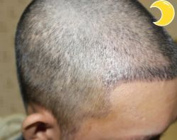 -大麦微针植发丨全国连锁