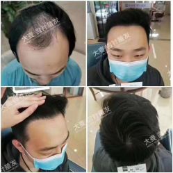 -大麦微针植发全国连锁