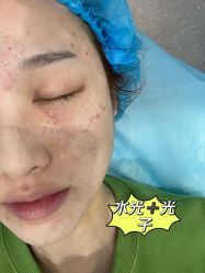 体验后-agge蛋白医美