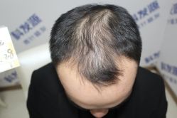 -大麦微针植发丨全国连锁