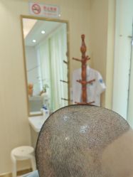 -碧莲盛·不剃发植发