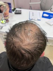 点击看大图 -碧莲盛·不剃发植发