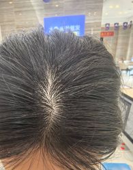 -大麦微针植发丨全国连锁