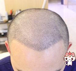 -大麦微针植发丨全国连锁