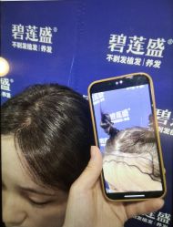 -碧莲盛·不剃发植发