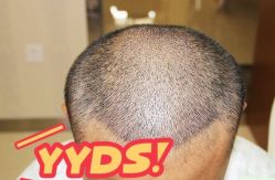 -大麦微针植发丨全国连锁