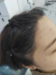 -大麦微针植发全国连锁