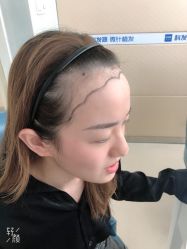 -大麦微针植发丨全国连锁