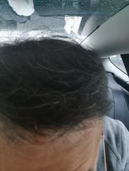 -大麦微针植发全国连锁