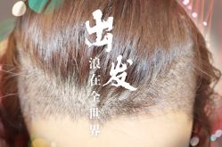 -大麦微针植发全国连锁