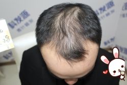 -大麦微针植发丨全国连锁