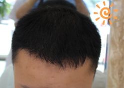 -大麦微针植发丨全国连锁