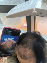 -碧莲盛·不剃发植发