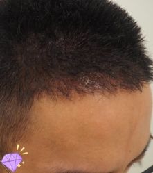 -大麦微针植发丨全国连锁