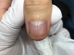 -Andrew指甲专科灰指甲·甲沟炎矫正·3D步态矫形鞋垫定制(上海法华镇路旗舰店)