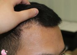 -大麦微针植发丨全国连锁