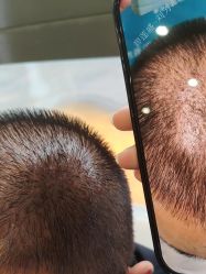 -碧莲盛·不剃发植发