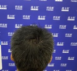 -碧莲盛·不剃发植发