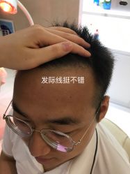 -大麦微针植发全国连锁