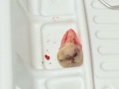 -上海仁爱医院口腔科 · 种植
