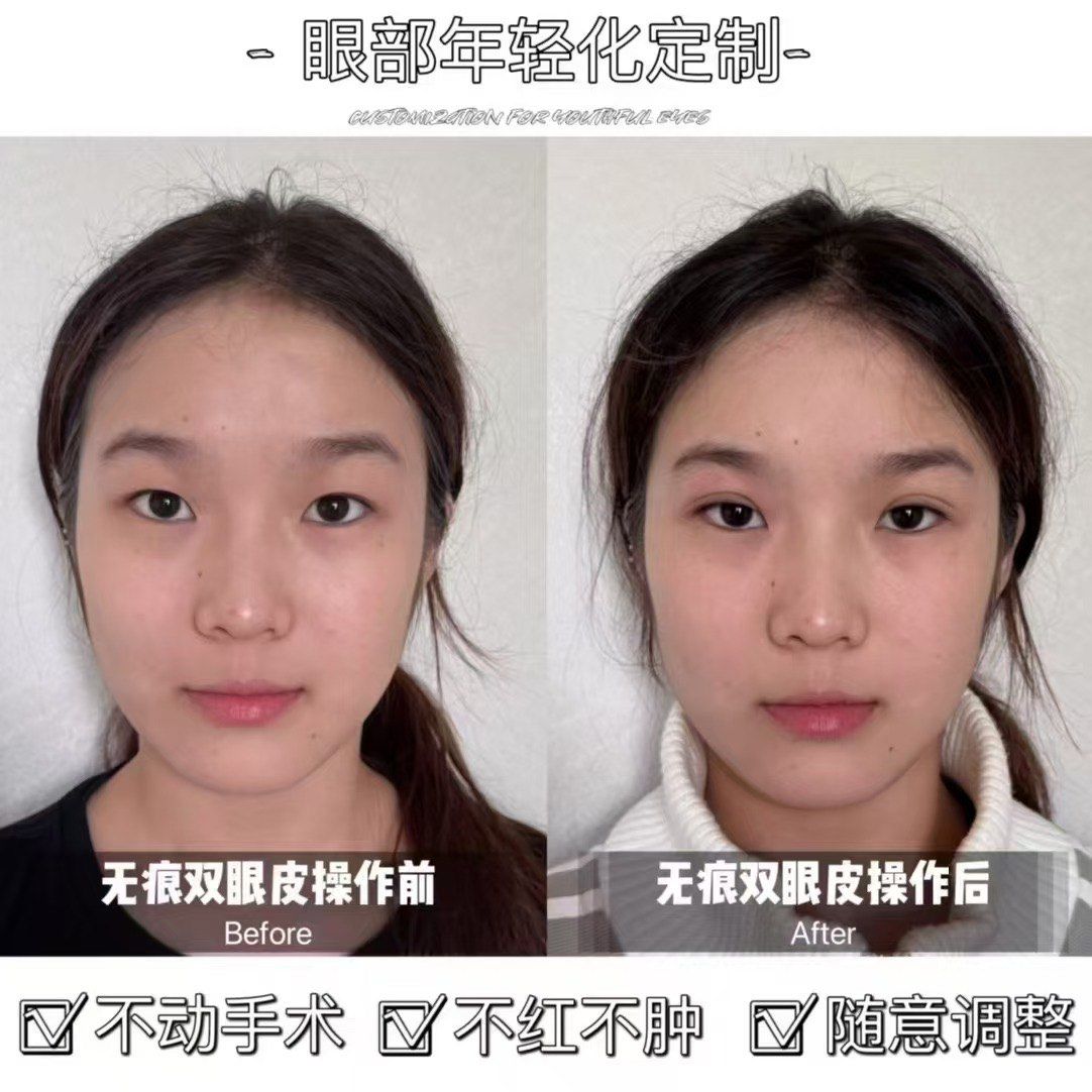 漂亮的双眼皮晒✨出来
小内双小姐姐做完

💎无痕眼综合