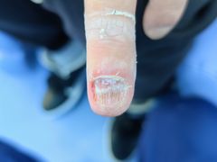 -Andrew指甲专科灰指甲·甲沟炎矫正·3D步态矫形鞋垫定制(浦三路店)